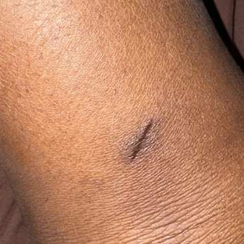 The Capital - My lingering scar from having shot glasses dropped next to my leg. - Dance Clubs Near Me - Cabo San Lucas, BCS The Capital - My lingering scar from having shot glasses dropped next to my leg. - Dance Clubs Near Me - Cabo San Lucas, BCS