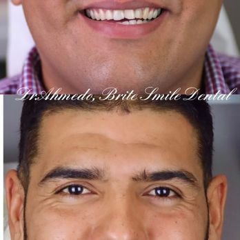 Brite Smile Dental - Before & After - Cosmetic Dentists Near Me - San Diego, California