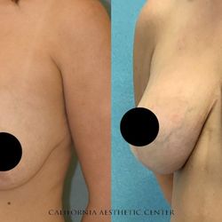 Steve T. Vu MD, FACS - Mastopexy (Breast Lift) + Removal & Replacement of Breast Implants. 
7 months post-procedure.