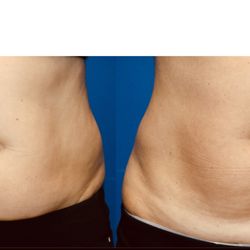 Kekoa Medical Spa - FlexSure 5 treatments