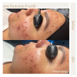 Klearology - Acne Bootcamp