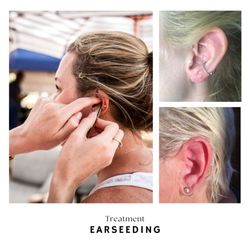 Emily Keaty Acupuncture - Earseeding stimulates acupressure points on the ear with tiny 24k gold plated seeds secured to the ear.