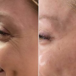 Dermabeauty Medical Spa - Before & After of Botox crows-feet