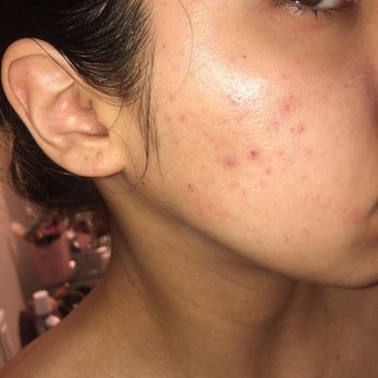 Affiliated Dermatology - breakouts - Dermatologists Near Me - Tempe, Arizona