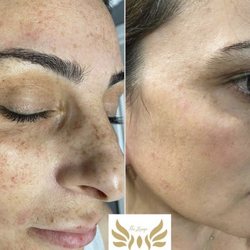 Ten beauty & Medi Spa - Lumcecca treatment