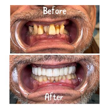 American Dental Group - ALL ON 4 - General Dentistry Near Me - West Covina, California American Dental Group - ALL ON 4 - General Dentistry Near Me - West Covina, California