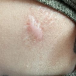 Buckeye Dermatology - Scar left after the removal of a lump