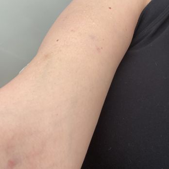 Restore Hyper Wellness - The only thing I left with was bruises.. - IV Hydration Near Me - Redondo Beach, California