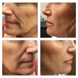 Sweet Spot Spa and Enrichment Center - restylane