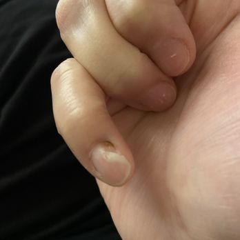Impressive Nails & Spa - 3/26 nail still isn't healing and turning  black - Nail Salons Near Me - Rancho Cucamonga, California