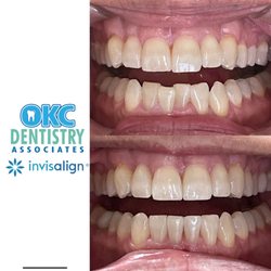 OKC Dentistry Associates - Artisan Dentalworks - Does the crowding of your lower teeth bother you? In just a few months we can help you get that confident smile you have always wanted!