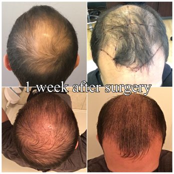 What Is Bosley Hair Restoration Reviews
