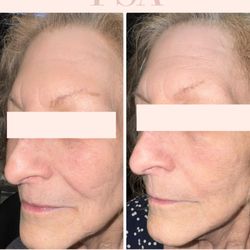 Pure Skin Aesthetics - Tixel skin tightening and rejuvenation