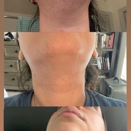 Laser hair removal.