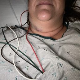 Admitted to IICU after botched lymph node biopsy & path showed 0 lymph node cells!!! Admitted to IICU after botched lymph node biopsy & path showed 0 lymph node cells!!!