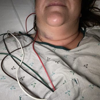 Corewell Health - Admitted to IICU after botched lymph node biopsy & path showed 0 lymph node cells!!! - Hospitals Near Me - Sterling Heights, Michigan Corewell Health - Admitted to IICU after botched lymph node biopsy & path showed 0 lymph node cells!!! - Hospitals Near Me - Sterling Heights, Michigan