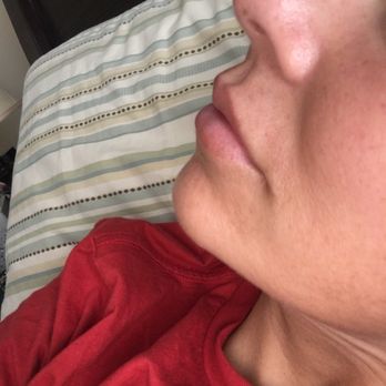 Wallis Dermatology Associates - 2 weeks after 2nd lip filler - Dermatologists Near Me - Longview, Texas Wallis Dermatology Associates - 2 weeks after 2nd lip filler - Dermatologists Near Me - Longview, Texas