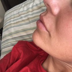 Wallis Dermatology Associates - 2 weeks after 2nd lip filler