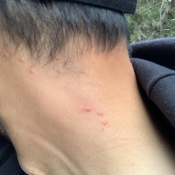 Hollister Inn - Bed Bug Bites. - Hotels Near Me - Hollister, California Hollister Inn - Bed Bug Bites. - Hotels Near Me - Hollister, California