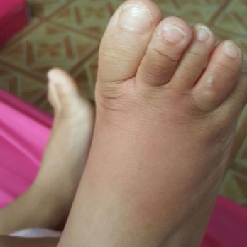 CoCo Key - My 3 year old foot after getting bit by the giant size roach! - Resorts Near Me - Orlando, Florida