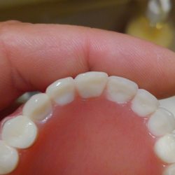 NDX Green - Foreign matter imbedded in Denture plate just below o Left tooth that is bigger and shaped different than rest of teeth