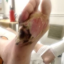 Emergency Room at Arizona General Hospital - Tempe - He's infection from Dr not giving him antibiotics! Now he's having toe amputated