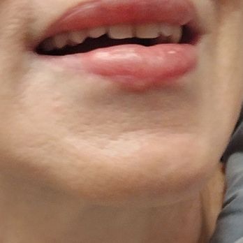 David D. Magilke MD - Another after injections - Cosmetic Surgeons Near Me - Portland, Oregon David D. Magilke MD - Another after injections - Cosmetic Surgeons Near Me - Portland, Oregon