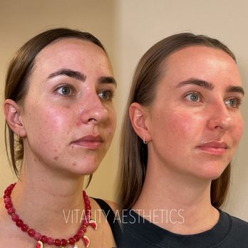 Vitality Aesthetics - Skin and acne improvements with facials membership - Skin Care Near Me - San Diego, California Vitality Aesthetics - Skin and acne improvements with facials membership - Skin Care Near Me - San Diego, California