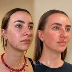 Vitality Aesthetics - Skin and acne improvements with facials membership