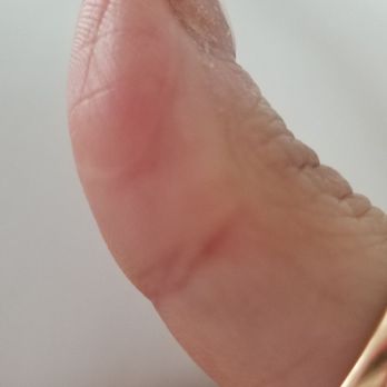 FastMed Urgent Care - Healed thumb - Doctors Near Me - Cary, North Carolina FastMed Urgent Care - Healed thumb - Doctors Near Me - Cary, North Carolina