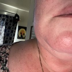 Absolute Dental - Topsy - This is the swelling on my face of the tooth he refused to pull