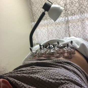 Advanced Traditional Acupuncture - Cupping - Acupuncture Near Me - Temecula, California