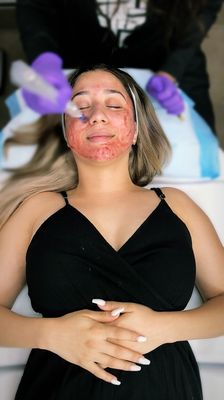 Microneedling with PRP - Microneedling with PRP (platelet rich plasma) also known as Collagen Induction Therapy, uses fine needles to create hundreds of tiny punctures in the skin’s top layer. These tiny wounds stimulate the body’s natural healing process, which helps reduce the signs of aging. This painless, noninvasive procedure promotes cell turnover and boosts collagen and elastin production to restore the skin’s elasticity. Microneedling also reduces fine lines and deep wrinkles, reverses sun damage, decreases hyperpigmentation, repairs scars, shrinks pores and improves absorption of skin care products to maximize their results. It can be performed on any area of the face and body. Microneedling with PRP - Microneedling with PRP (platelet rich plasma) also known as Collagen Induction Therapy, uses fine needles to create hundreds of tiny punctures in the skin’s top layer. These tiny wounds stimulate the body’s natural healing process, which helps reduce the signs of aging. This painless, noninvasive procedure promotes cell turnover and boosts collagen and elastin production to restore the skin’s elasticity. Microneedling also reduces fine lines and deep wrinkles, reverses sun damage, decreases hyperpigmentation, repairs scars, shrinks pores and improves absorption of skin care products to maximize their results. It can be performed on any area of the face and body.