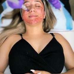 Embrace Vanity - MicroNeedling with PRP