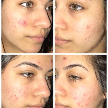 Dr Bouyarden Center - A couple of days difference after the chemical peel. The top is the before and the bottom is after. - Medical Spas Near Me - Bellaire, Texas Dr Bouyarden Center - A couple of days difference after the chemical peel. The top is the before and the bottom is after. - Medical Spas Near Me - Bellaire, Texas
