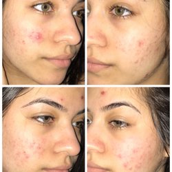Casablanca Anti-Aging & Laser Centre - A couple of days difference after the chemical peel. The top is the before and the bottom is after.