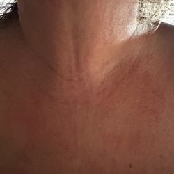 Anne Arundel Dermatology - Glen Burnie - Day 2 of Allergic reaction to BACITRACIN!