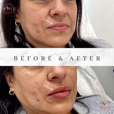 Lips Fillers: Get That Perfect Pout! - Lip fillers are valued for their ability to enhance and restore lip volume, contour, and symmetry. By providing a non-invasive and customizable solution, lip fillers empower individuals to achieve their desired aesthetic, boosting confidence and rejuvenating their overall appearance. This quick and easy procedure offers natural-looking results, making it a popular choice for those seeking subtle yet impactful enhancements! Call or visit us online to book! Lips Fillers: Get That Perfect Pout! - Lip fillers are valued for their ability to enhance and restore lip volume, contour, and symmetry. By providing a non-invasive and customizable solution, lip fillers empower individuals to achieve their desired aesthetic, boosting confidence and rejuvenating their overall appearance. This quick and easy procedure offers natural-looking results, making it a popular choice for those seeking subtle yet impactful enhancements! Call or visit us online to book!