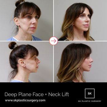SK Plastic Surgery - Deep plane face lift. - Cosmetic Surgeons Near Me - Beverly Hills, California SK Plastic Surgery - Deep plane face lift. - Cosmetic Surgeons Near Me - Beverly Hills, California