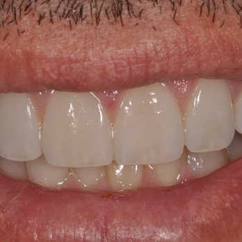 Haber Dental Center - After - Cosmetic Dentists Near Me - Glendora, California Haber Dental Center - After - Cosmetic Dentists Near Me - Glendora, California