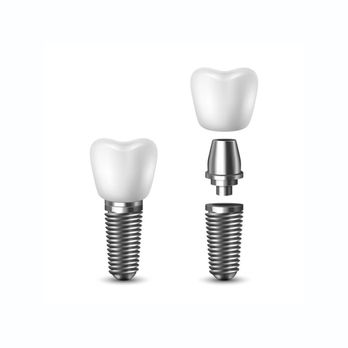 Louisville Dentures and Implants - Single tooth implants are the best way to repair damaged or missing teeth in a localized area. - Cosmetic Dentists Near Me - Louisville, Kentucky Louisville Dentures and Implants - Single tooth implants are the best way to repair damaged or missing teeth in a localized area. - Cosmetic Dentists Near Me - Louisville, Kentucky