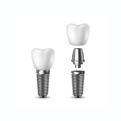 Louisville Dentures and Implants - Single tooth implants are the best way to repair damaged or missing teeth in a localized area.