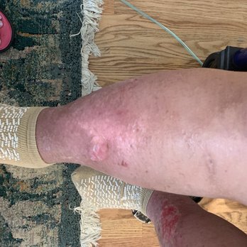 Visiting Nurse Health System - Took five visits to have someone properly wrap these wounds. - Home Health Care Near Me - Atlanta, Georgia Visiting Nurse Health System - Took five visits to have someone properly wrap these wounds. - Home Health Care Near Me - Atlanta, Georgia
