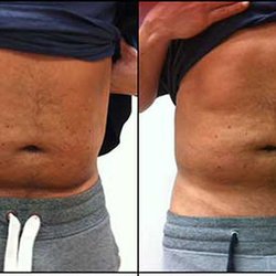 Style Mobb Studio Salon and Boutique - Before and after Ultrasonic Cavitation