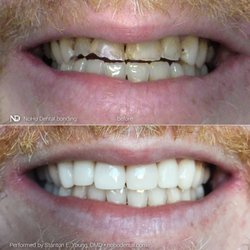 Stanton E Young, DMD - Dental bonding by Dr. Stanton Young can be a lasting and less invasive alternative to costlier methods.