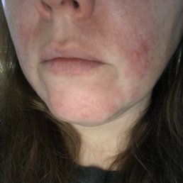 My skin ruined from a peel My skin ruined from a peel