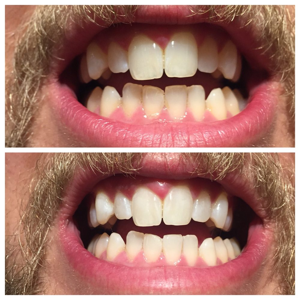 GLOW TEETH WHITENING 15 Photos & 17 Reviews Teeth Whitening 6000