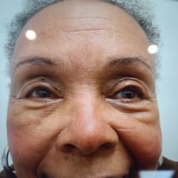 East Bay Ophthalmology - After