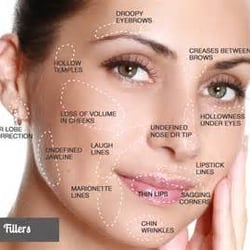 Filler - Restylane, Juvederm, Radiesse