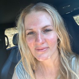 Extractions & light peel